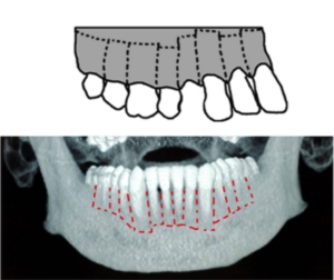 Traitement corticotomies
