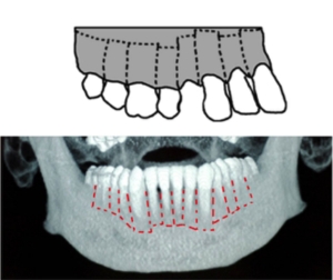 Traitement corticotomies