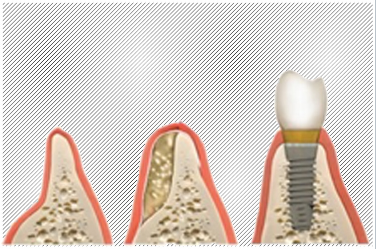 Pose d'implant dentaire