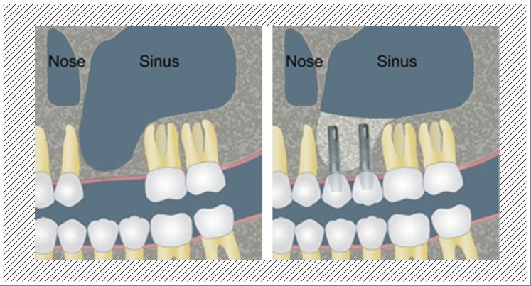 Pose d'implant dentaire