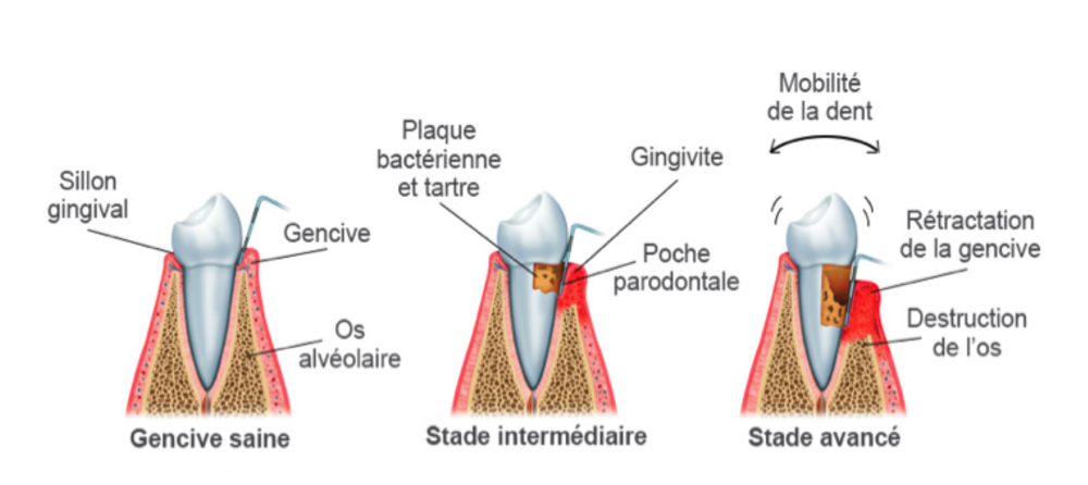 Traitement parodontite